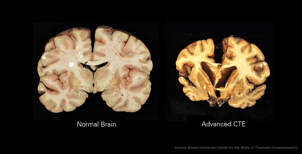 brain injuries showing